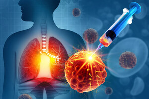 70세 넘은 3기 폐암 환자도 ‘적극적 치료’ 가능